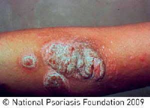 Scientists led by Washington University School of Medicine in St. Louis have identified the first gene directly linked to the most common form of psoriasis. Rare mutations in the CARD14 gene, when activated by an environmental trigger, can lead to plaque psoriasis, which accounts for 80 percent of all cases of the condition. (Credit: National Psoriasis Foundation)