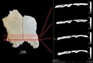 A fragment of a child's skull discovered at Olduvai Gorge, Tanzania, shows the oldest known evidence of anemia caused by a nutritional deficiency. (Credit: Dominguez-Rodrigo M, Pickering TR, Diez-Martin F, Mabulla A, Musiba C, et al. (2012) Earliest Porotic Hyperostosis on a 1.5-Million-Year-Old Hominin, Olduvai Gorge, Tanzania. PLoS ONE 7(10): e46414. doi:10.1371/journal.pone.0046414)