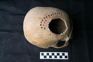 Some 900 years ago, a Peruvian healer used a hand drill to make dozens of small holes in a patient's skull. (Credit: Danielle Kurin)