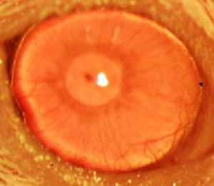 This is a restored functional cornea following transplantation of human limbal stem cells to limbal stem cell-deficient mice.