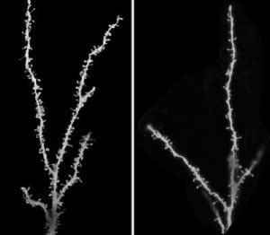 In a study of brains from children with autism, researchers found that autistic brains did not undergo normal pruning during childhood and adolescence. The images show representative neurons from autistic (left) and control (right) brains; the spines on the neurons indicate the location of synapses.