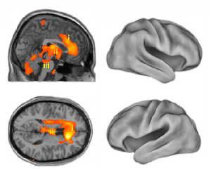 PET scans show that the return of consciousness after anesthesia involves ancient brain structures that evolved long ago, rather than the more recent neocortex. Side and top down views show activation of the anterior cingulate cortex (i), thalamus (ii) and the brainstem (iii) overlaid on magnetic resonance image slices.