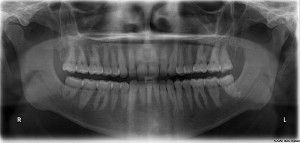 X-ray of all 32 human teeth