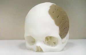 A 3-D printing process that binds granules of an inert polymer with a laser has allowed researchers to create customized pieces of skull (shown). In an example not pictured, scientists recently replaced 75 percent of a man’s skull with a custom prosthetic.