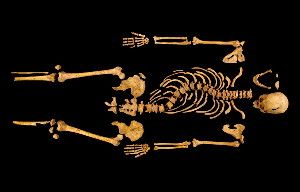 The recently excavated bones of England's King Richard III bear witness to his infamous life and death. Severe scoliosis curved his spine, which may have been painful and made it difficult to breathe. Of the 10 wounds discovered on his skeleton, two are candidates for the death blow: a blade plunged up through the bottom of his skull and gash with an axe-like weapon that took off part of the back of his head.