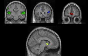 Listening to new music sparks activity in brain regions that analyze sound (green), recognize patterns (blue), process emotions (red), and determine rewards (rainbow, at bottom). Activity in the nucleus accumbens (rainbow) could predict how much money people were willing to spend on a new song. This person (brain image shown) wanted to pay the maximum amount — $2 — for a song.