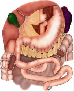 Schematic of gastric bypass using a Roux-en-Y anastomosis. The transverse colon is not shown so that the Roux-en-Y can be clearly seen.