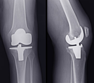 Knee replacement image courtesy of iStockphoto/33karen33