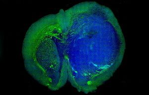 A new technique generates colored images that differentiate tumor tissue (blue) in a mouse brain from surrounding healthy tissue (green). The technique may eventually improve brain surgery.
