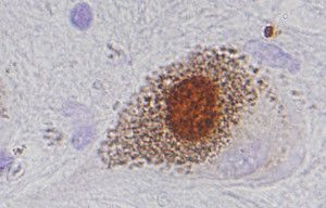 A Lewy body, made up of the alpha-synuclein protein (brown) sits inside a neuron in the brain of a patient with Parkinson’s disease.