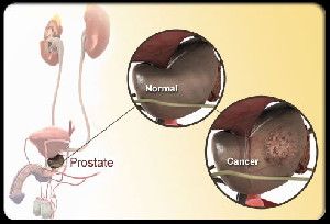 Prostate cancer