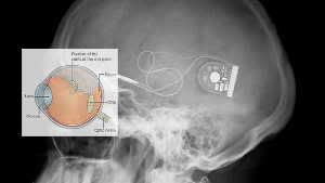 Retinal implant