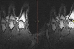 An MRI image of the same hand before knuckle cracking (left) and after (right), showing the void (dark spot) in the joint fluid that forms when the knuckles are cracked.