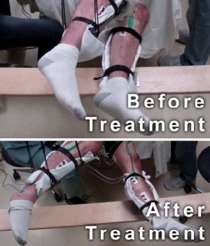 This image shows the range of voluntary movement prior to receiving stimulation compared to movement after receiving stimulation, physical conditioning, and buspirone. The subject's legs are supported so that they can move without resistance from gravity. The electrodes on the legs are used for recording muscle activity.