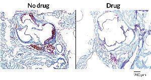 GUT CHECK  Mice predisposed to heart disease and fed a diet high in choline — a compound found in meat and eggs — had plaque buildup in their arteries (left: plaques, red; artery, blue). Mice also given a drug to prevent their gut microbes from breaking down the choline had much less artery clogging (right).