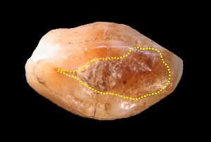 Image Caption: This is a microphotograph of the tooth crown in occlusal view with indication of the surface covered by beeswax (within the yellow dotted line). Credit: Bernardini F, Tuniz C, Coppa A, Mancini L, Dreossi D, et al. (2012) Beeswax as Dental Filling on a Neolithic Human Tooth. PLoS ONE 7(9): e44904. doi:10.1371/journal.pone.0044904