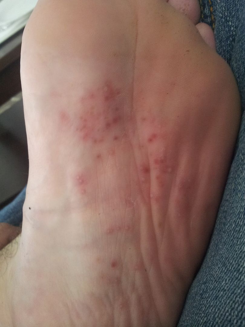 Rash on bottom of foot? | Yahoo Answers